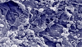 İmmün hücreler nano malzemelerle birleşince kanserle savaşı arttırıyor